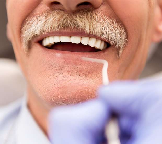 Brevard Adjusting to New Dentures