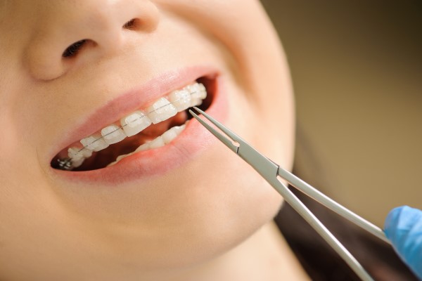 Options For Adult Invisible Braces