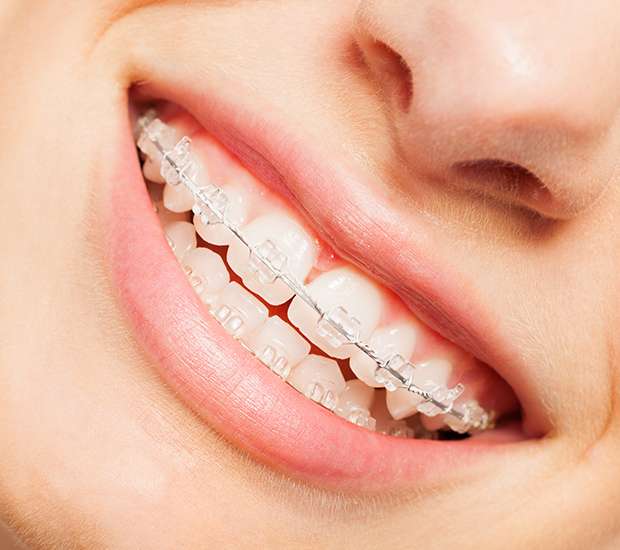 Brevard Clear Braces