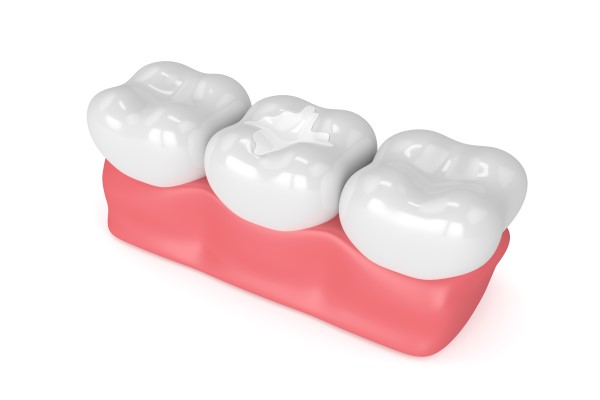 How Long Does A Dental Filling Last?