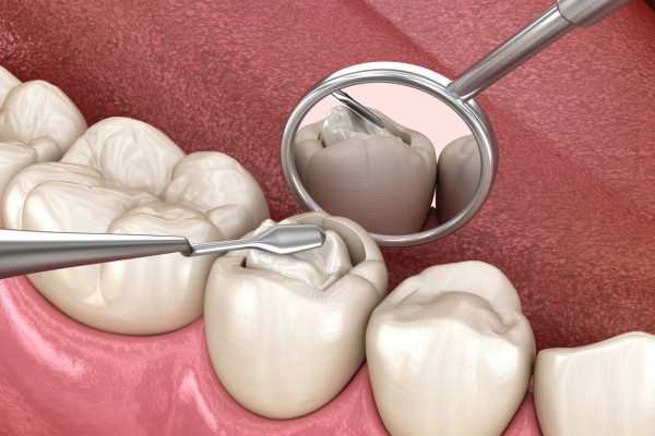 Prevent Further Tooth Decay With Dental Fillings