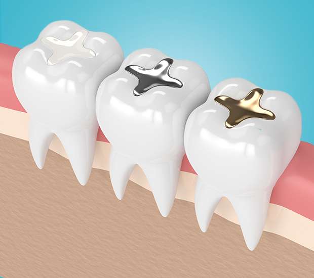 Brevard Composite Fillings