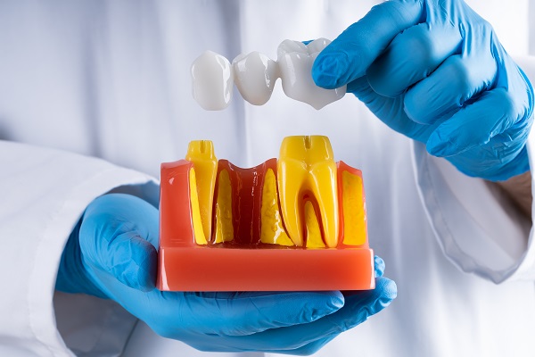 Improve Your Oral Health With A Dental Bridge