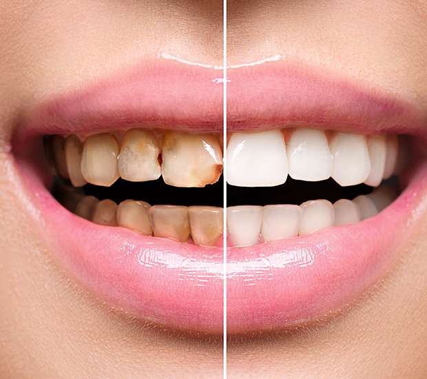 Brevard Dental Implant Restoration