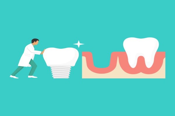 Dental Implants Are A Solution For Missing Teeth