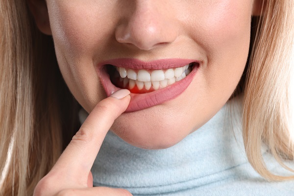 Important FAQs About Gum Disease