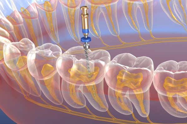 How Long Is Recovery From A Root Canal?