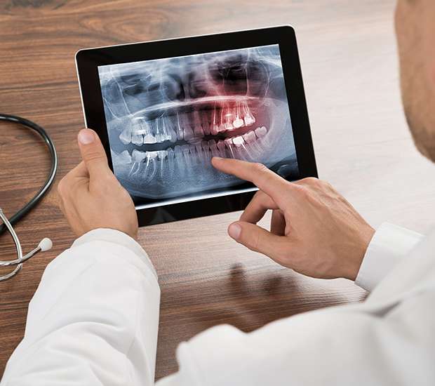 Brevard Types of Dental Root Fractures